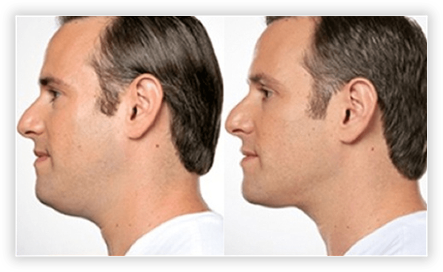 Non Surgical Facelift 2